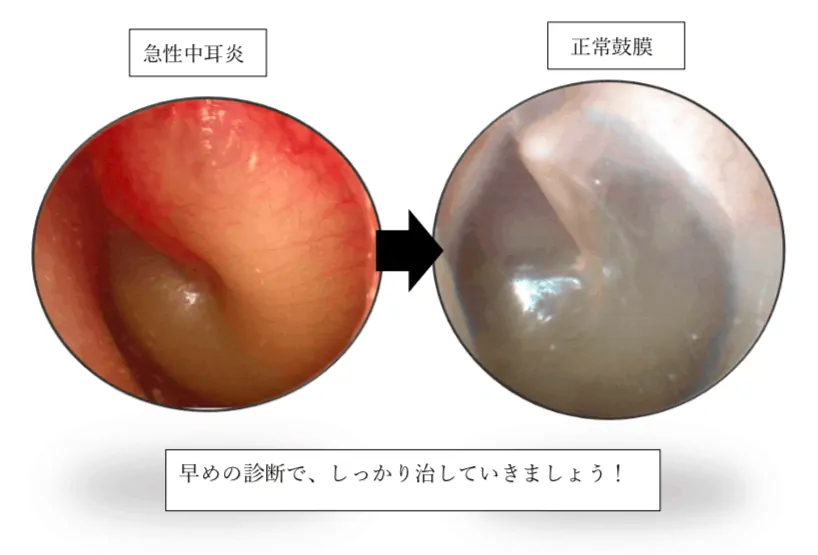 急性中耳炎時と正常な鼓膜を比較した画像
